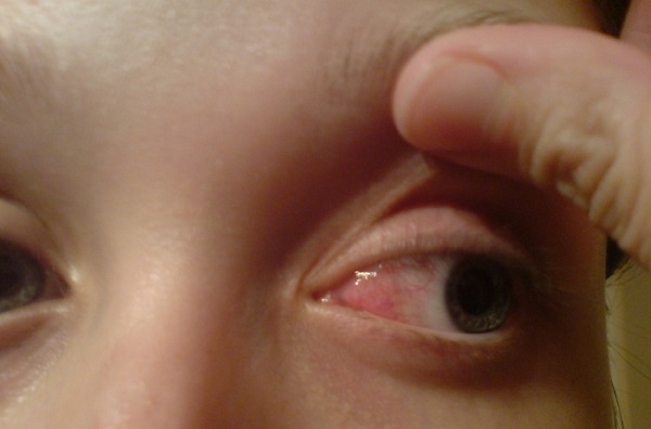 Чем лечить воспаление глаза