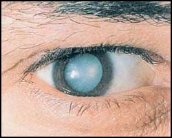 лечение катаракты глаза